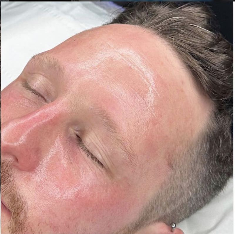 Gentleman's skin after Hydrafacial treatment